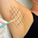 Tratament transpirație excesivă cu substanță neuromodulatoare (hiperhidroză) - Doctor SKiN