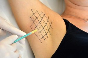 Tratament transpirație excesivă cu substanță neuromodulatoare (hiperhidroză) - Doctor SKiN