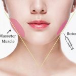 Slimming face cu toxină botulinică - Doctor SKiN