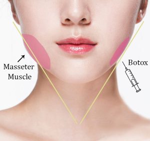 Slimming face cu toxină botulinică - Doctor SKiN