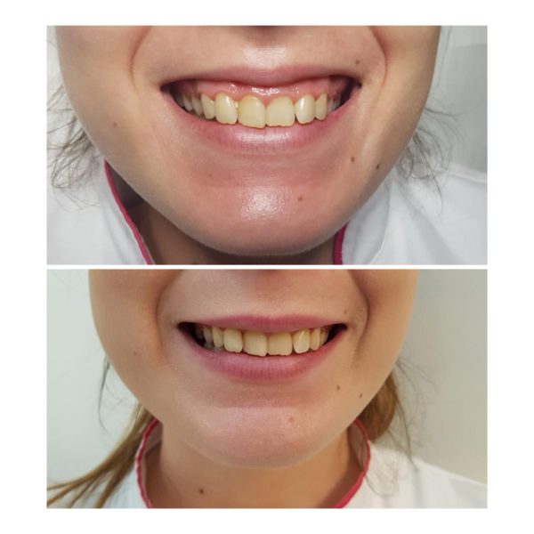 Corectarea zâmbetului gingival cu toxină botulinică