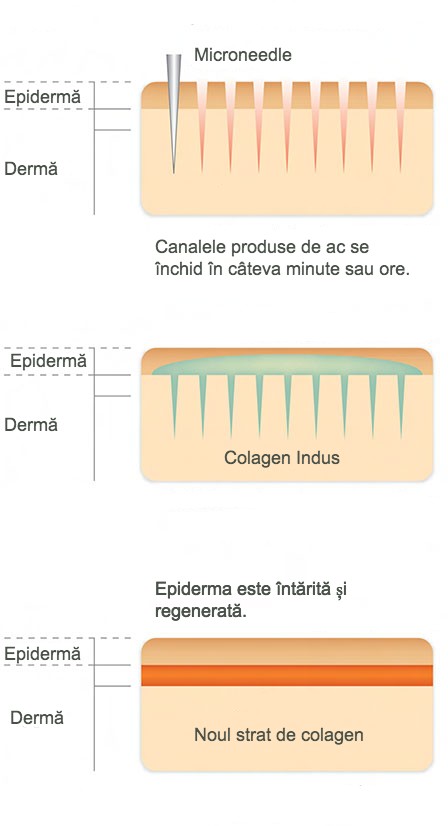 Terapia de inducere a colagenului